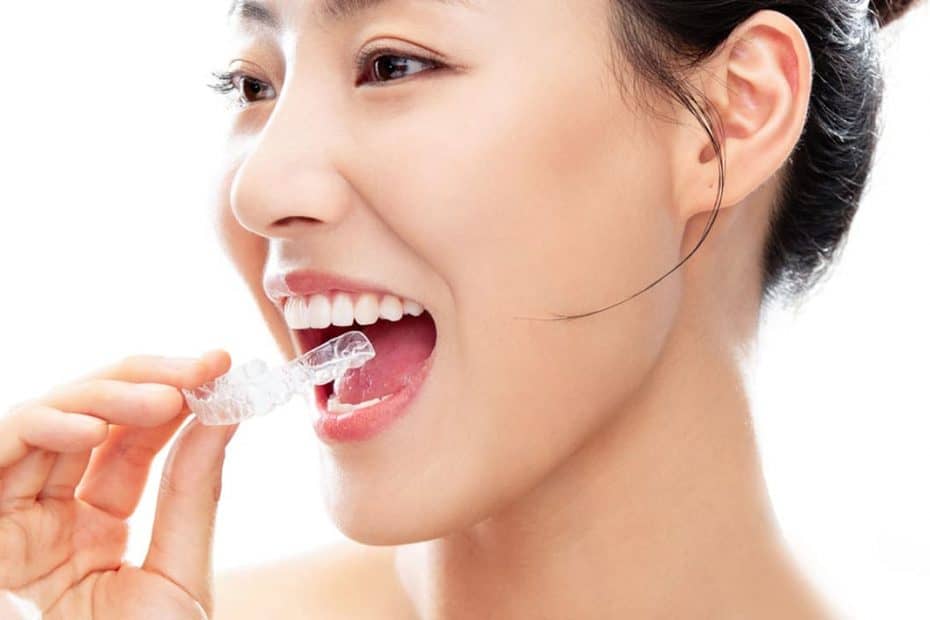 Clear Aligners