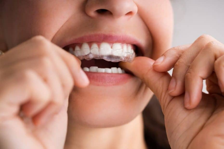 Straightening Teeth