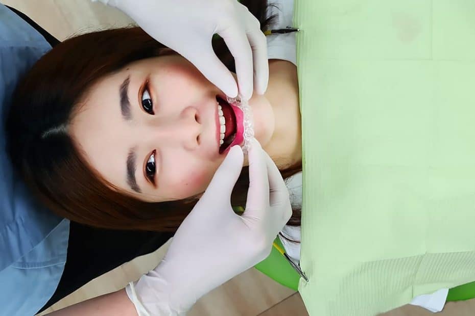Wearing Clear Aligners