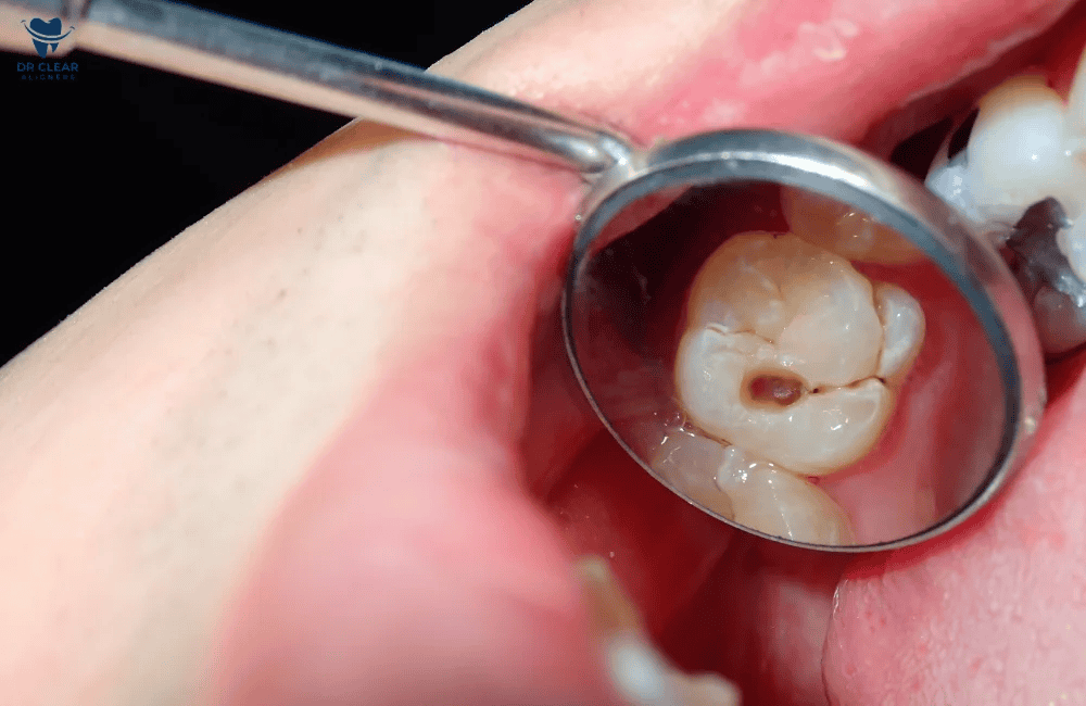 ระยะของฟันผุ เช็กระดับความรุนแรง