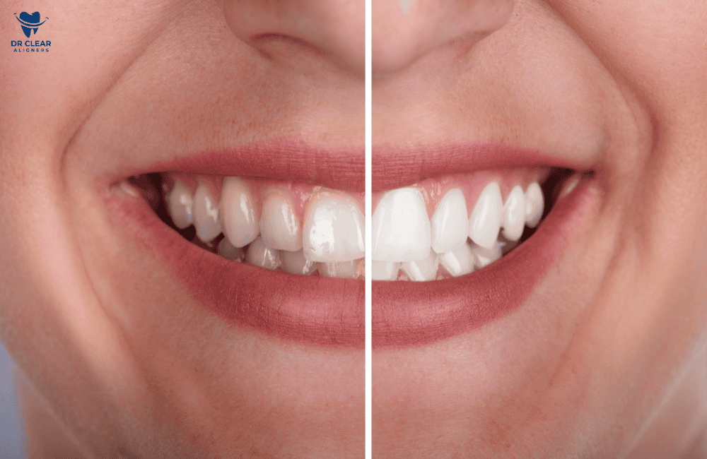 ใครบ้างที่เหมาะกับการฟอกฟันขาว