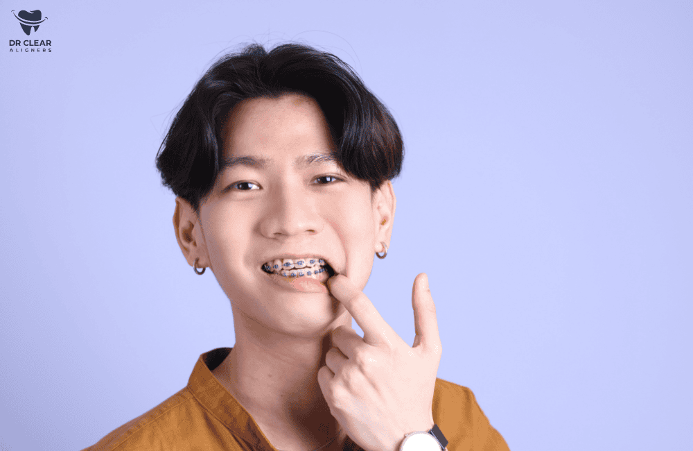 จัดฟันแฟชั่น